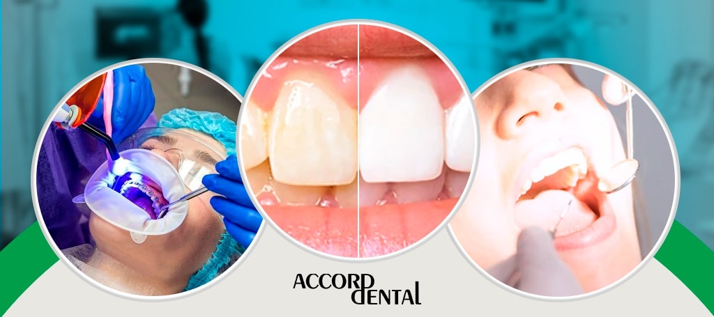 Accord Dental